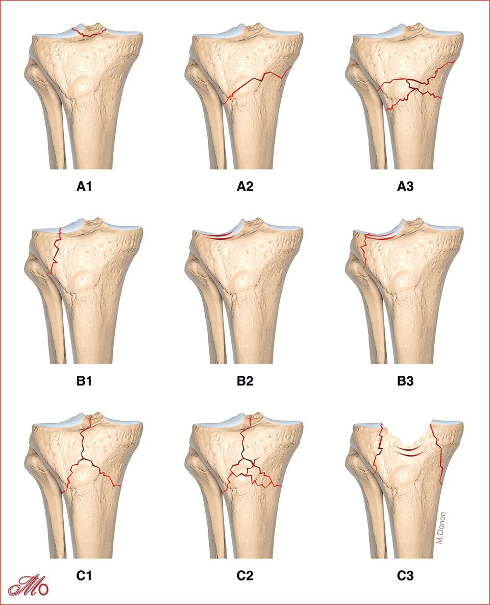 Prise En Charge Des Fractures Du Plateau Tibial Diagnostic Classification Et Traitement 8445