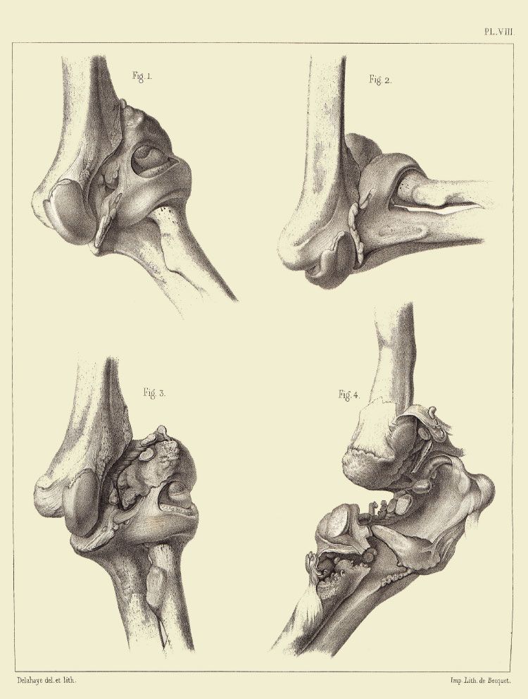 Extrait De L Atlas Du Trait Des Fractures Et Des Luxations Planche