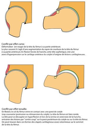 Le conflit antérieur de hanche Physiopathologie imagerie et