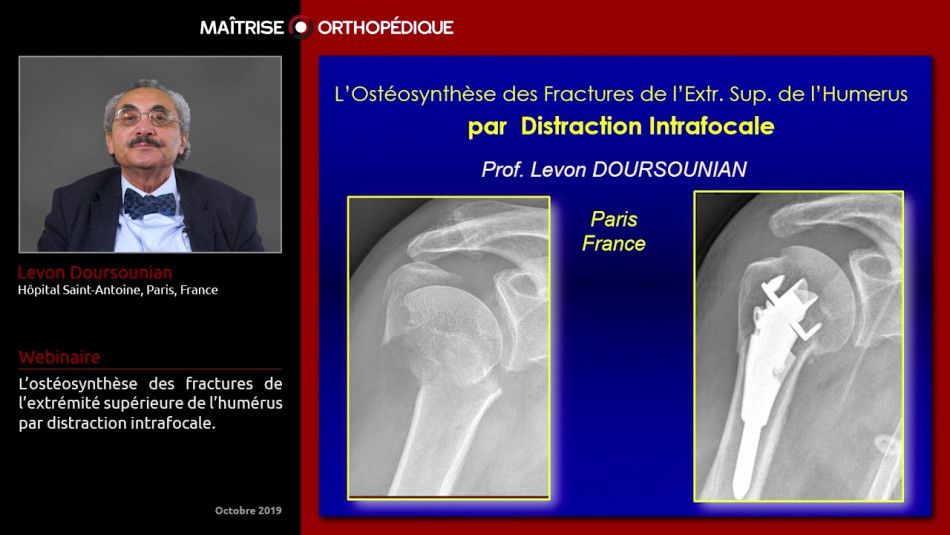 Ost Osynth Se Des Fractures De L Extr Mit Sup Rieure De L Hum Rus Par