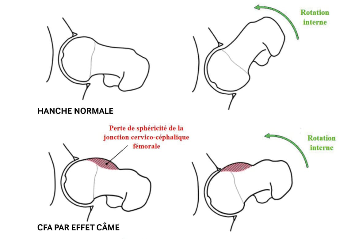 Comment faire le diagnostic dun conflit fémoro acétabulaire