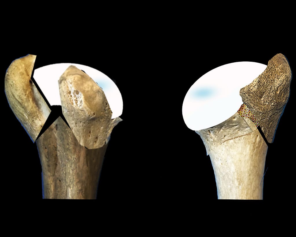 Traitement des fractures - Orthosud Montpellier